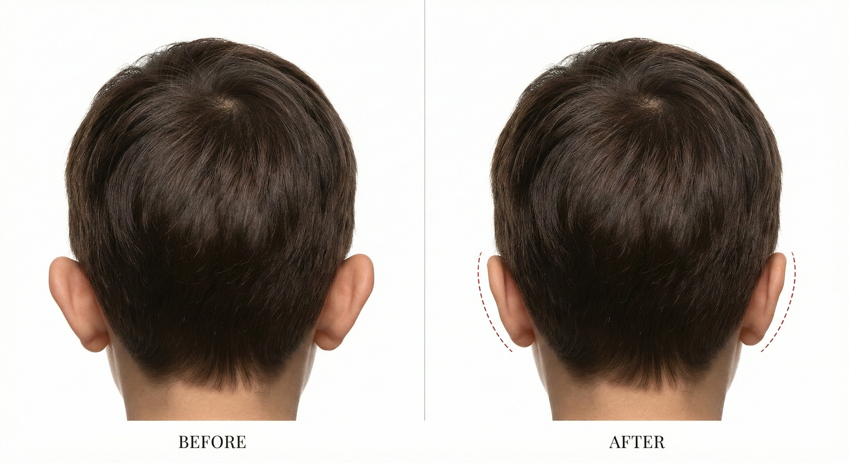 Otoplastika Nəticə 1