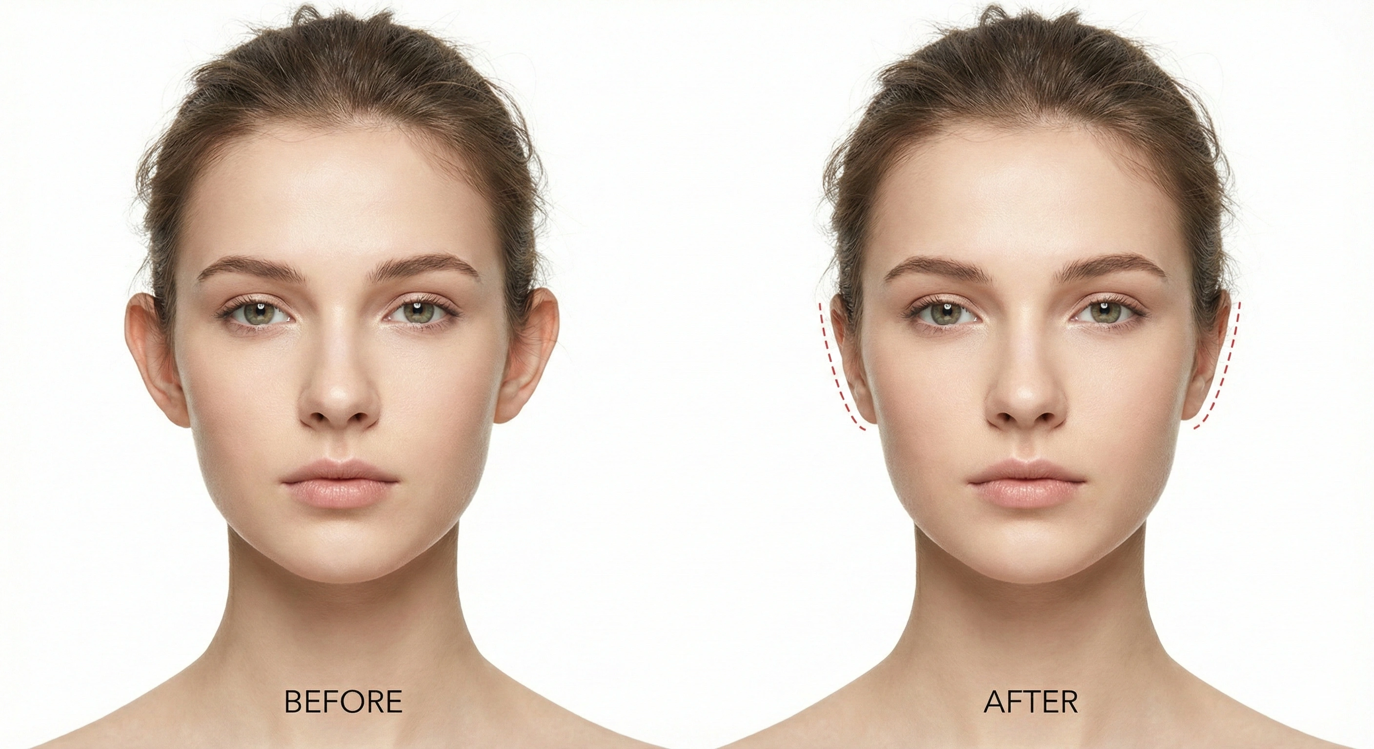 Otoplastika Nəticə 2